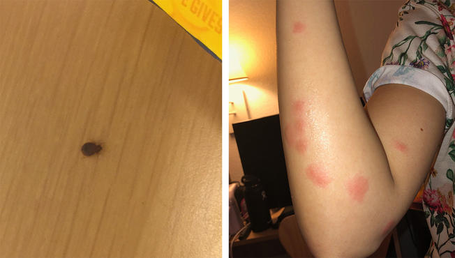 Bed Bugs in Hotel: ‘The Itch Was Unbearable’